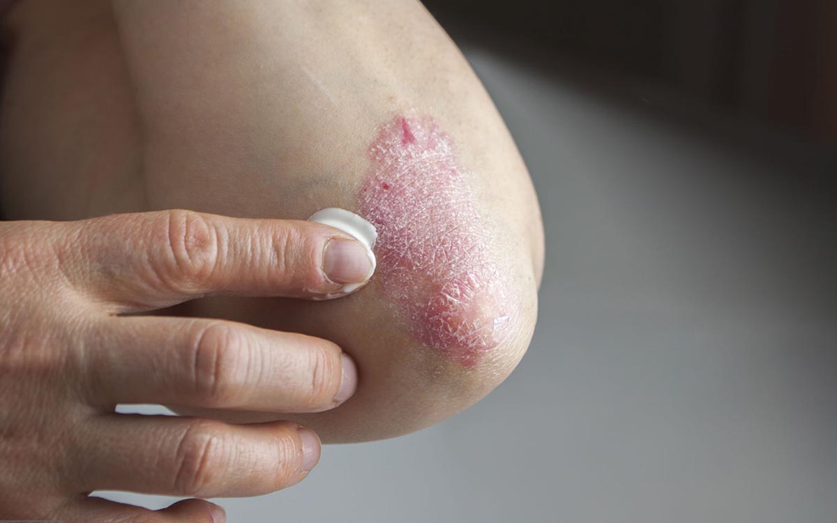 migliore crema aiuto per psoriasi