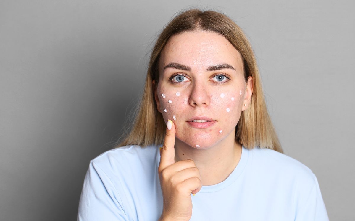 Crema per acne ormonale e giovanile: scopri il potere naturale